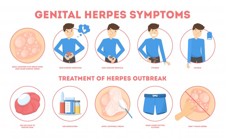 Myths about herpes