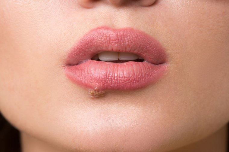 Cold Sores Oral Facial Herpes